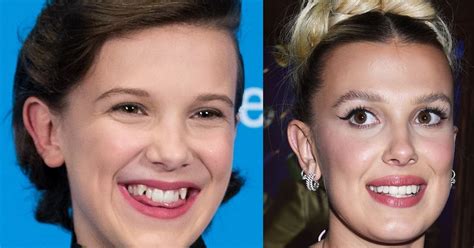 millie bobby brown braces.